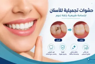 حشوات-تجميلية-للأسنان-ابتسامة-طبيعية حشوات-تجميلية-للأسنان-ابتسامة-طبيعية
