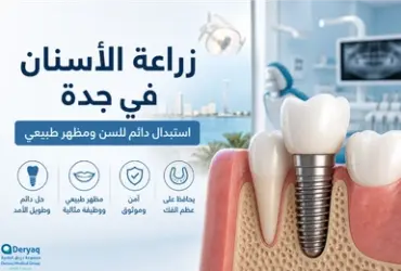 زراعة-الأسنان-في-جدة-حل-دائم-لاستعادة-ا زراعة الأسنان في جدة: حل دائم لاستعادة ابتسامتك